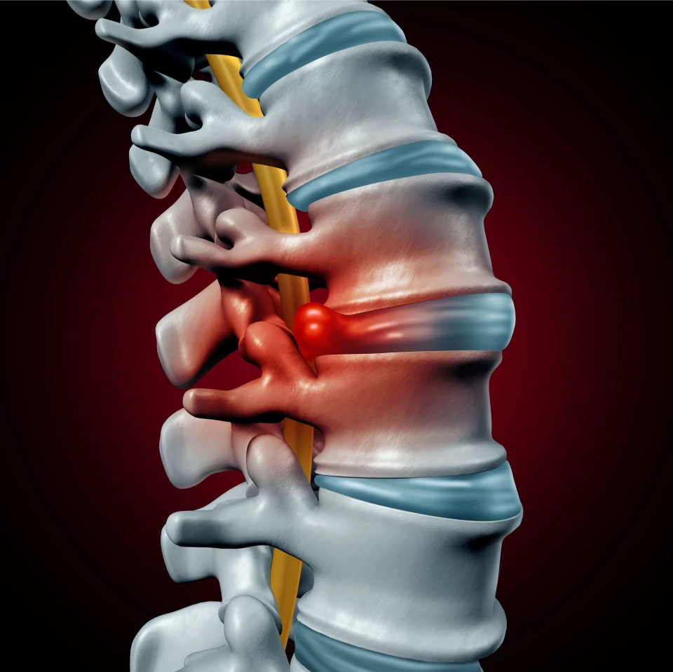 bulging or protruding disc