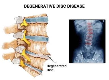disc degeneration