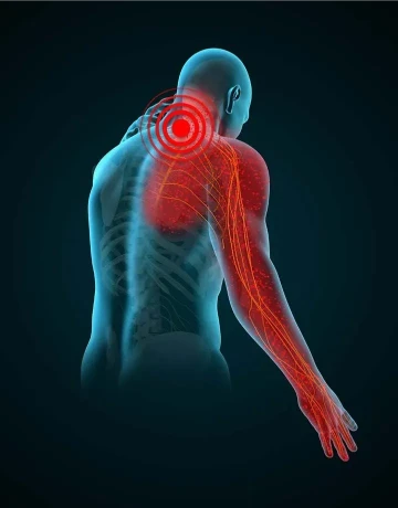 cervical radiculopathy