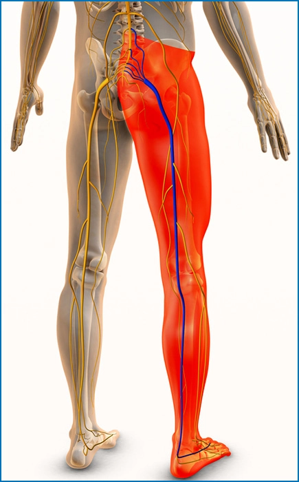 Pain from sciatica